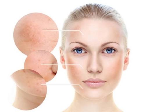 điều trị nám