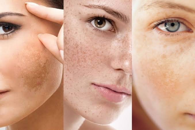 điều trị nám